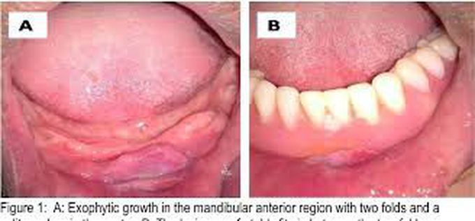 Treatment of denture induced hyperplasia