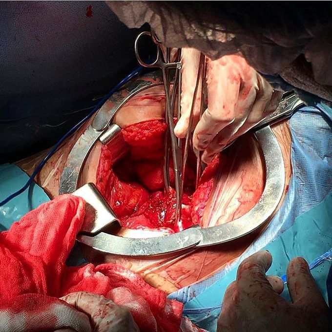 Total hysterectomy on a 31 year old female!