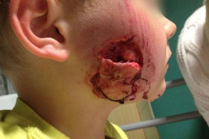 Dog attack leaving a boy with a gaping hole in his cheek!  