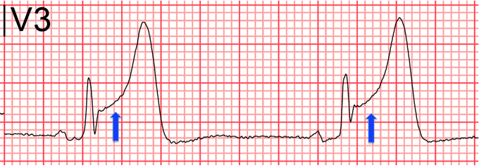 Differential Diagnosis of ST-segment Elevation on ECG