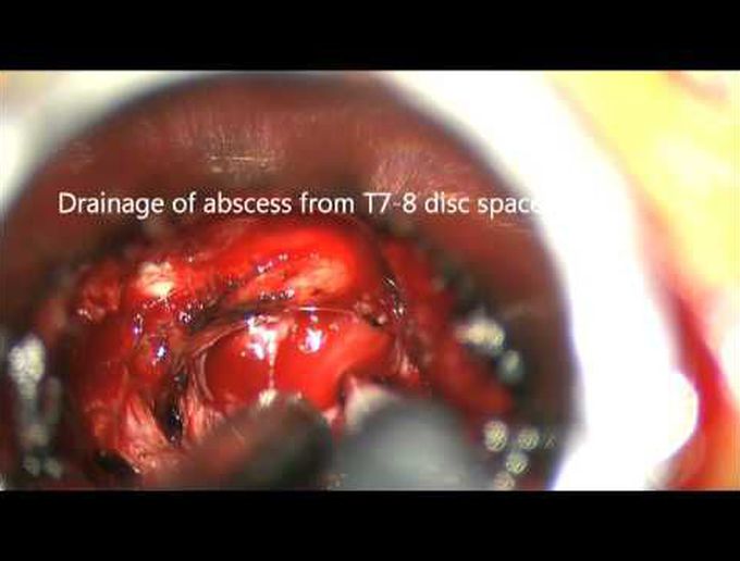 Minimally invasive transpedicular approach for evacuation of epidural abscess