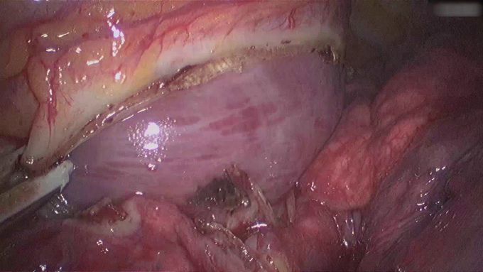 Laqueation of a Giant Aneurysm of the Left Atrial Appendage Using VATS Approach