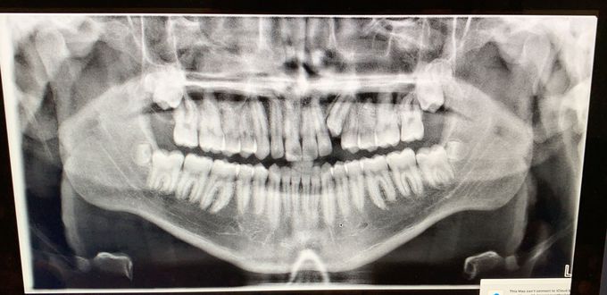 8 Wisdom teeth
