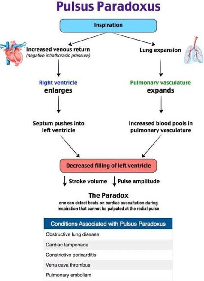 Pulsus Paradoxus