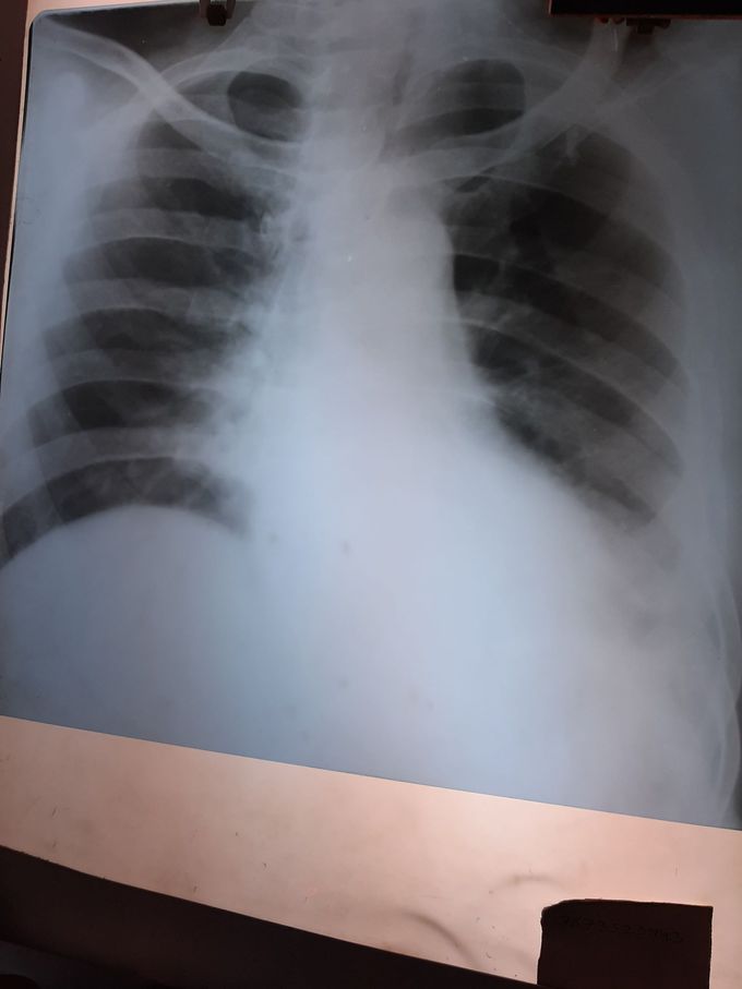 Chest xray