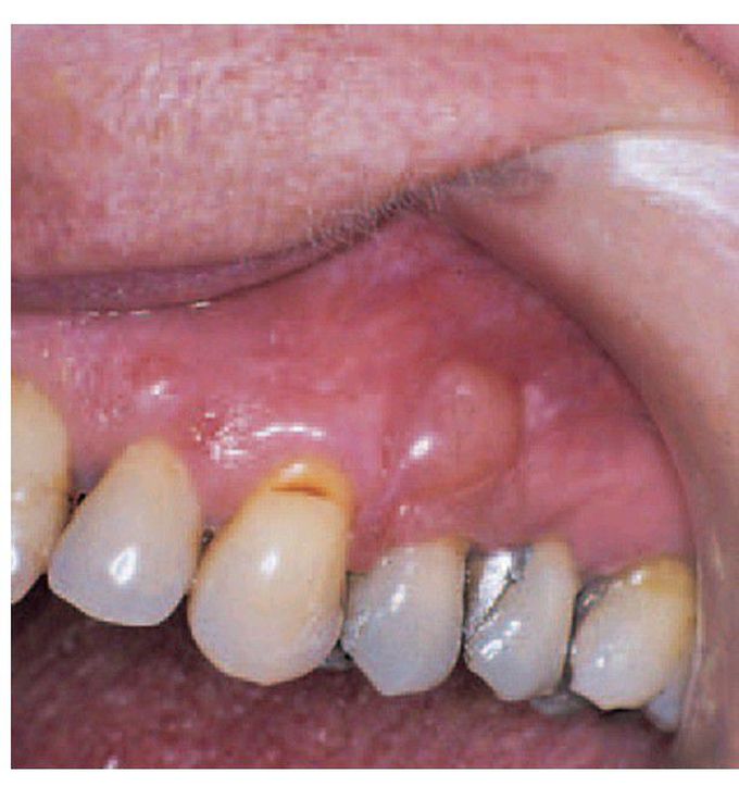 Gingival cyst of adult
