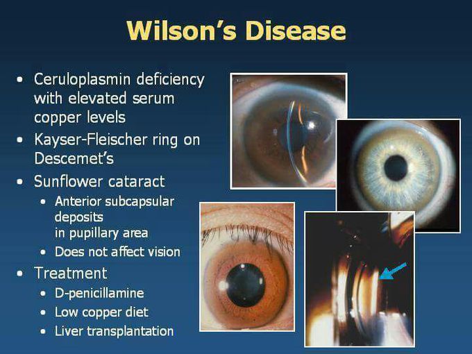 Wilson'sdisease