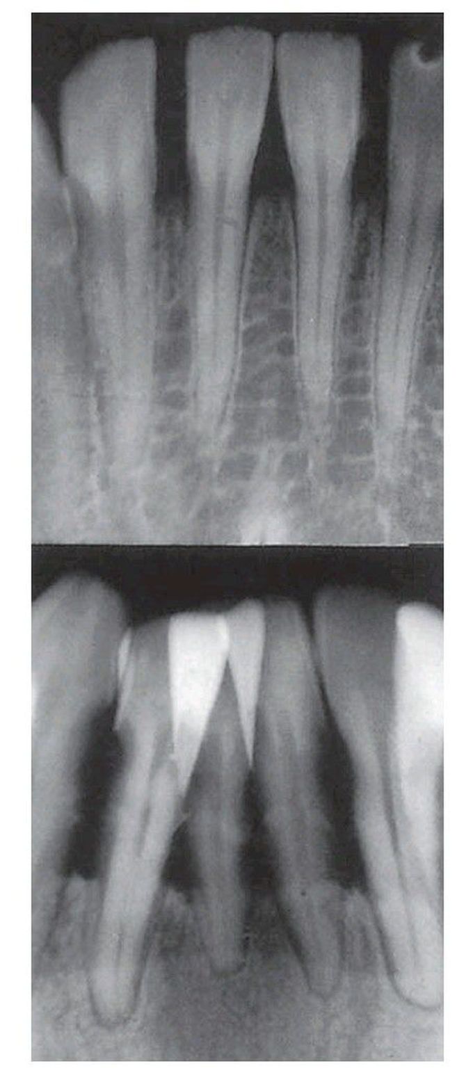 Chronic periodontitis