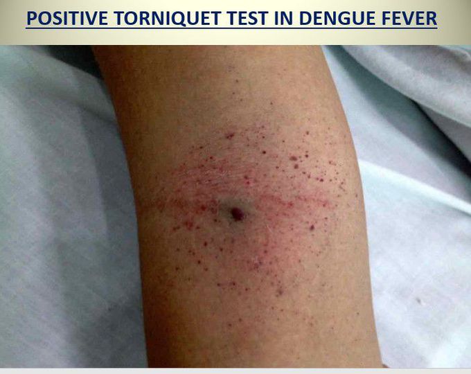 Positive Torniquet Test