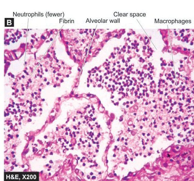 Lobar pneumonia