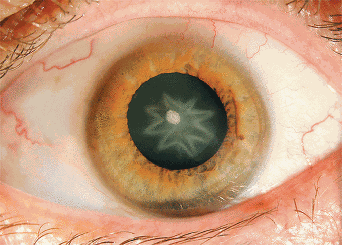 Stellate Cataract