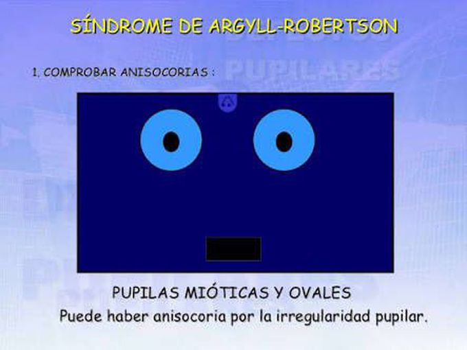 Pupila Argyll-RObertsOn