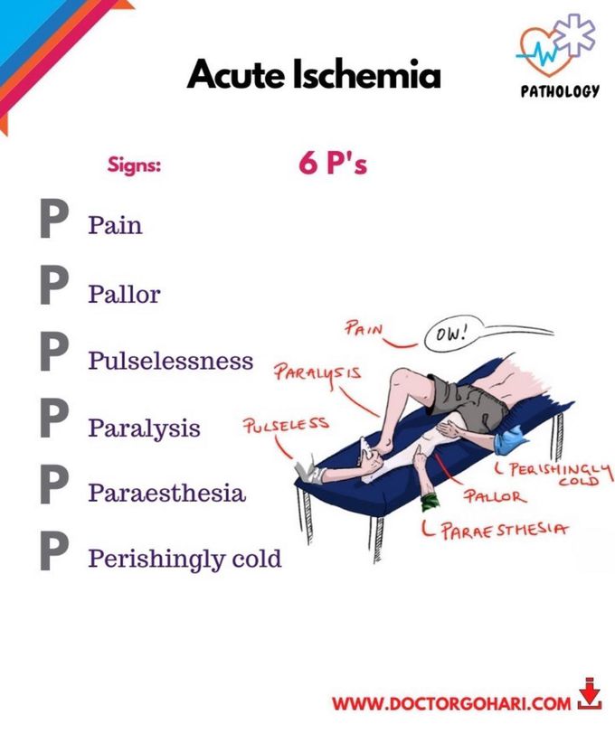 Acute Limbic Ischemia