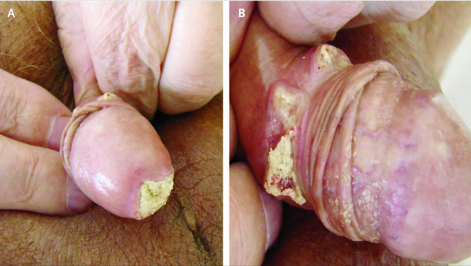 Atypical Ulcerations of the Penis