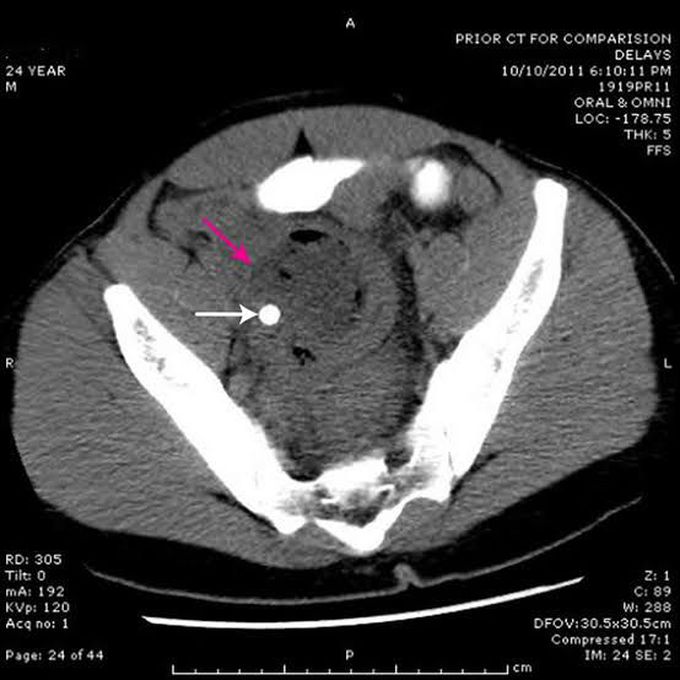 Symptoms of Pelvic Abscess