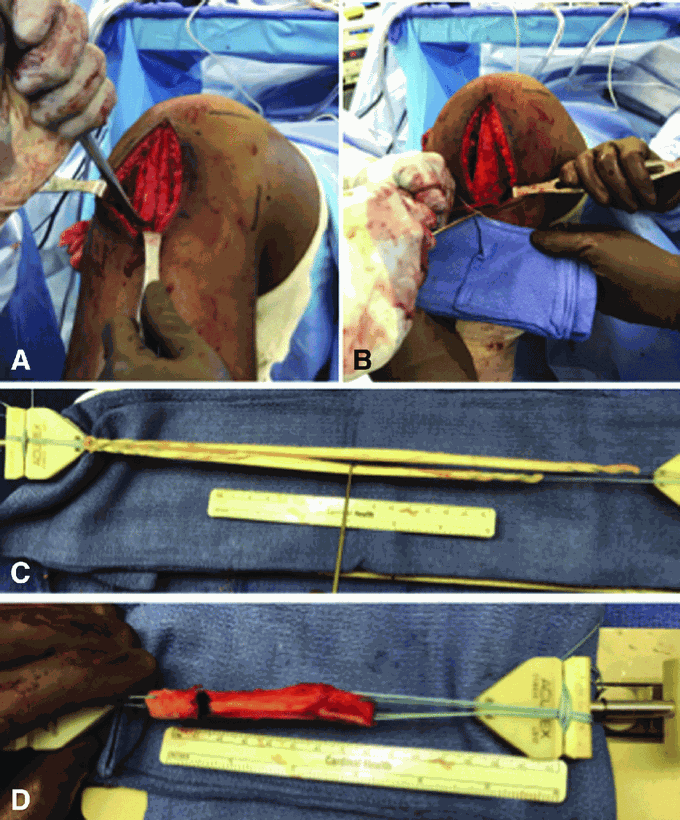 Intraoperative images, right knee
