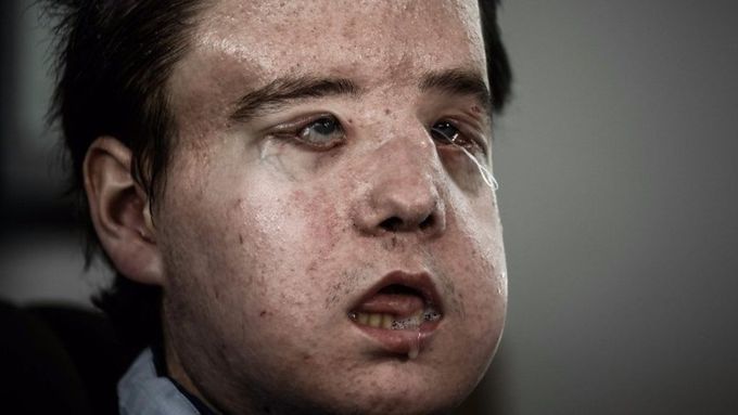 Man gets 'third face' in French transplant