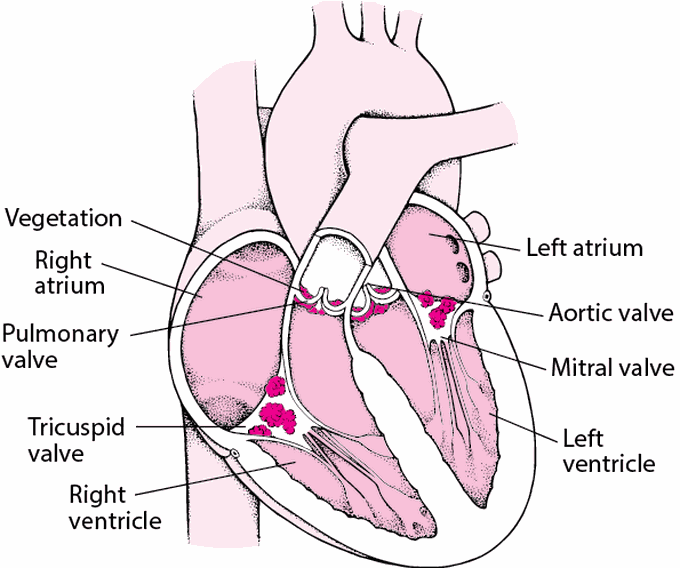 causes of infective endocarditis