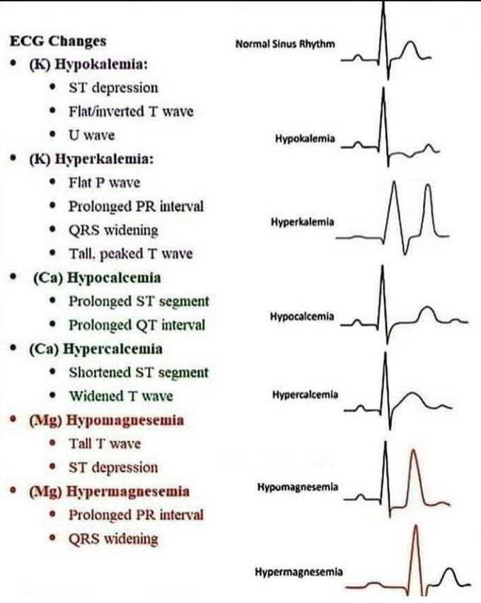 ECG Changes