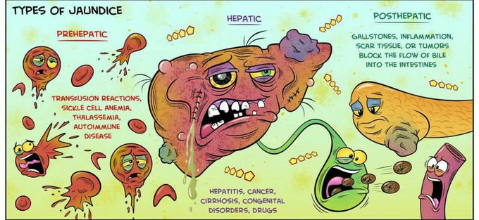 Types of Jaundice...