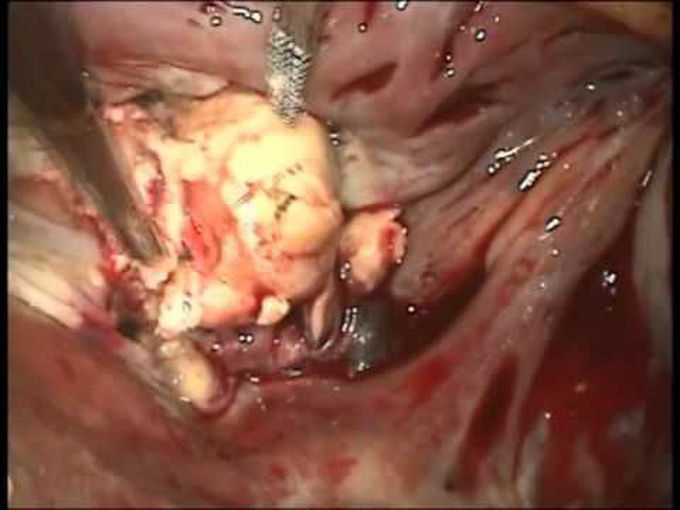 Tricuspid Valve Replacement for Severe Invasive Endocarditis