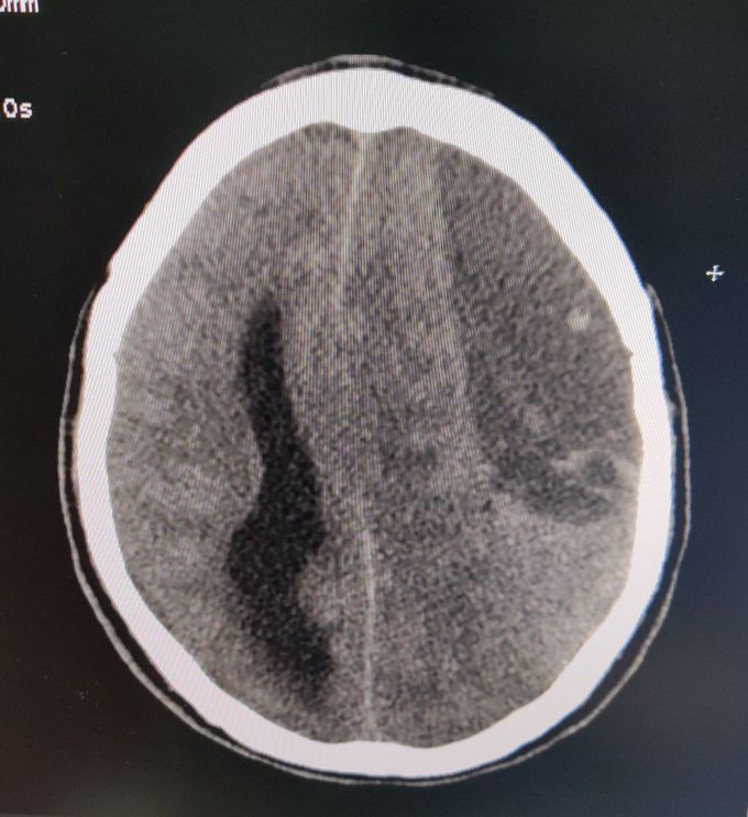 Ischemic CVA or Epidural Hematoma ?