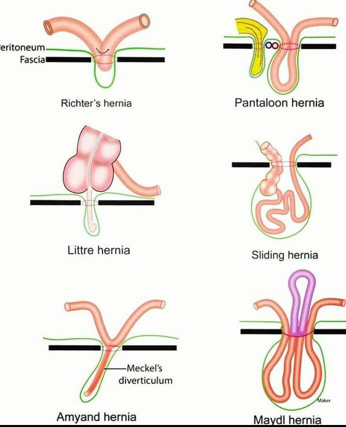 Different types of hernia