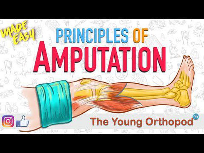 Basic Amputation Principles