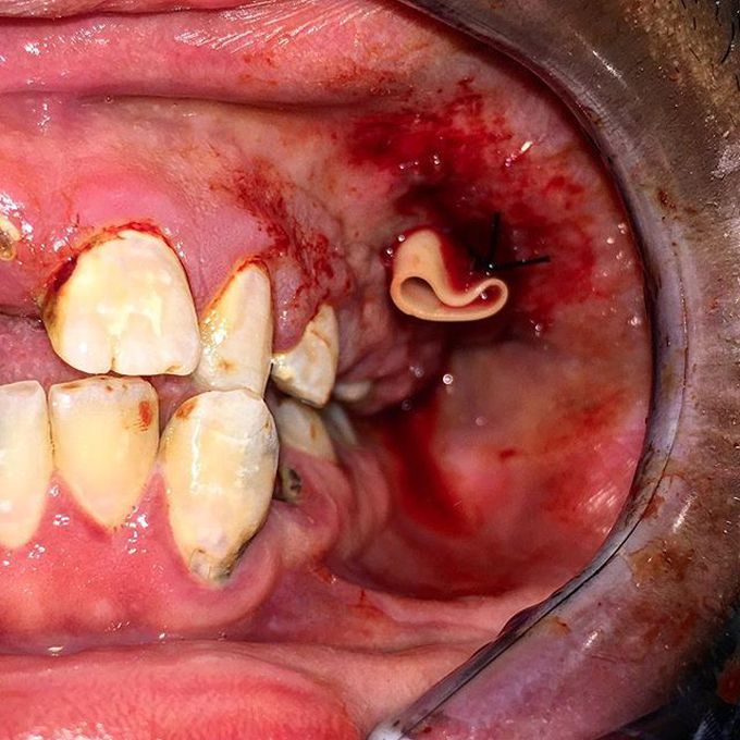 Incision and drainage with penrose drain placement 📌 