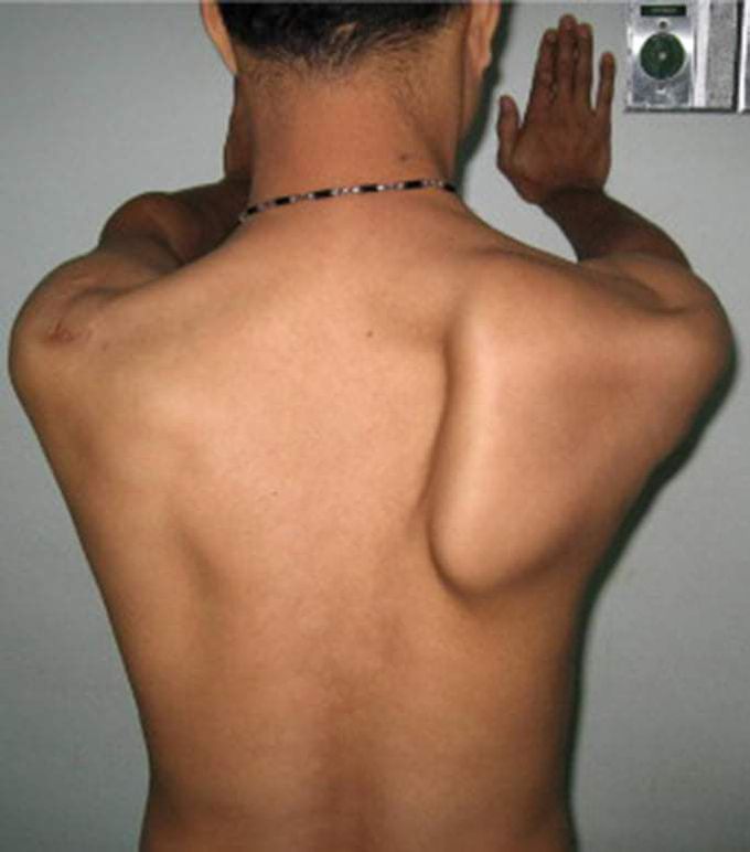 Poland syndrome