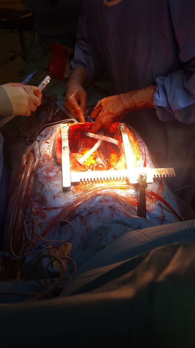 Cardiac transplant