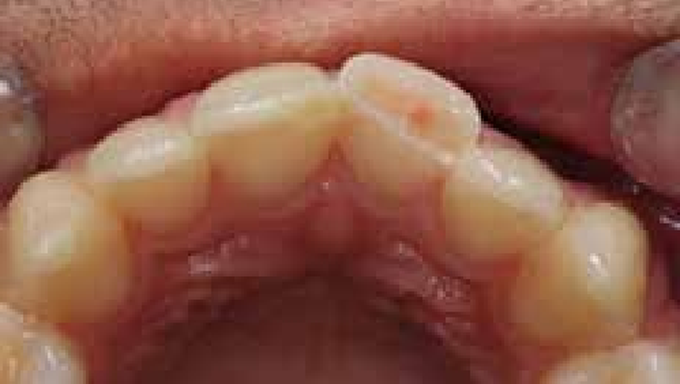 Enamel-dentine fracture