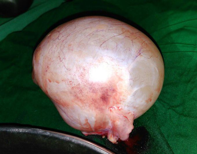 Women 34 years old with Stomaches in lower right quadrant abdomen.  Right ovarian cyst of neoplasm