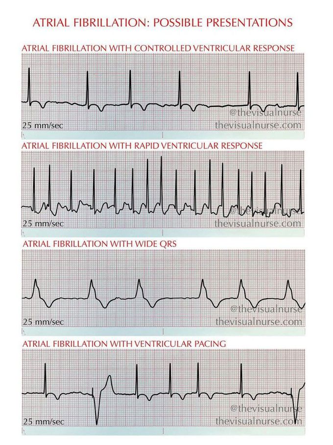 Atrial Fibrillation