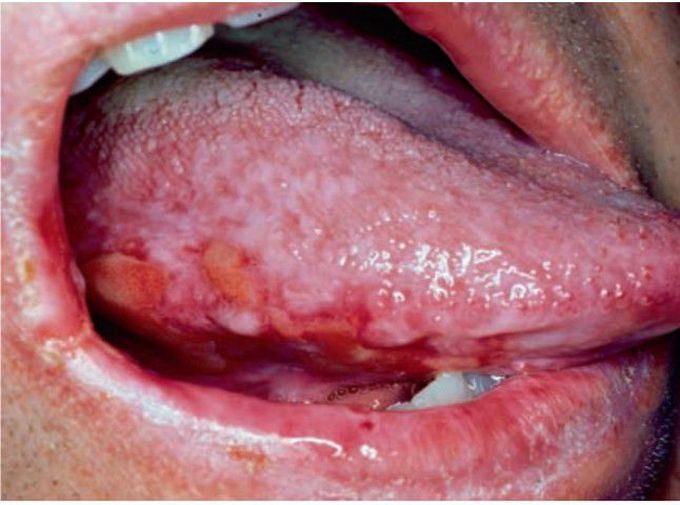 Lichenoid drug reaction