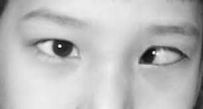 Gradenigo's Syndrome- When infection of the ear paralyses the eye!