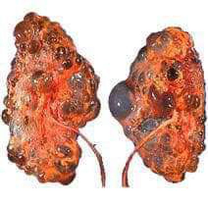 Can you mention any causes of this renal condition?