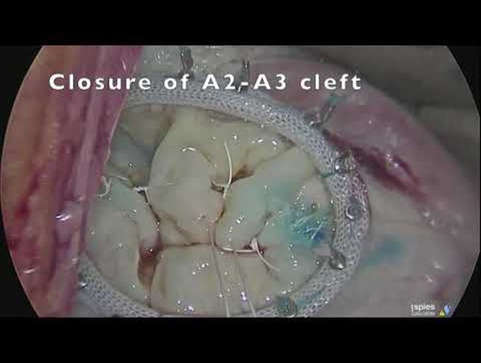 Around the Mitral Valve With Nonresectional Repair Techniques