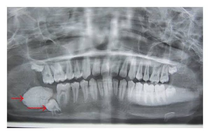Complex odontoma