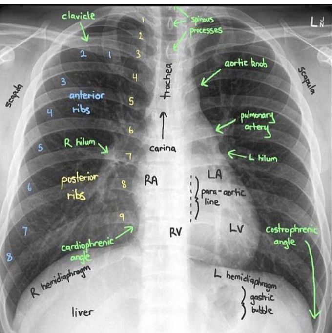 Chest X-ray Interpretation