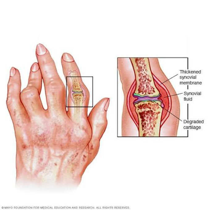 Treatment of rheumatoid arthritis
