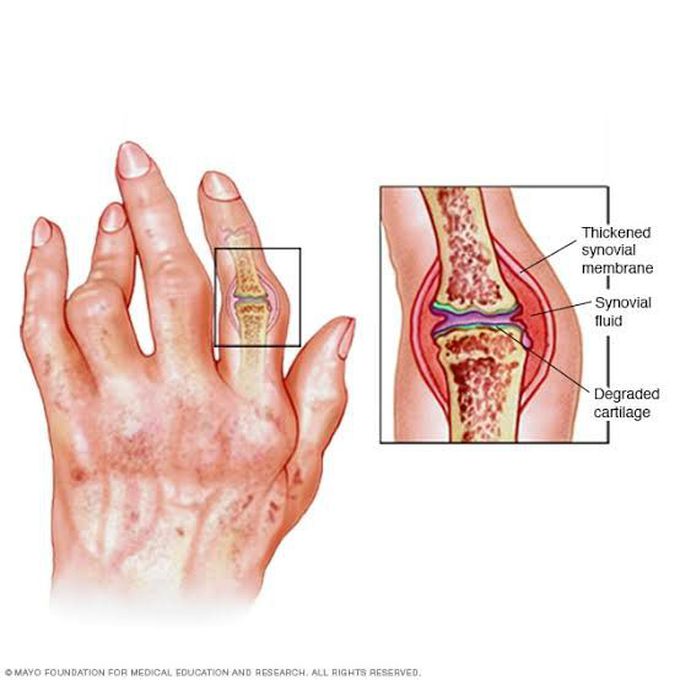 Treatment of rheumatoid arthritis