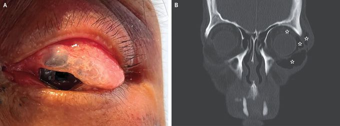 Orbital Emphysema