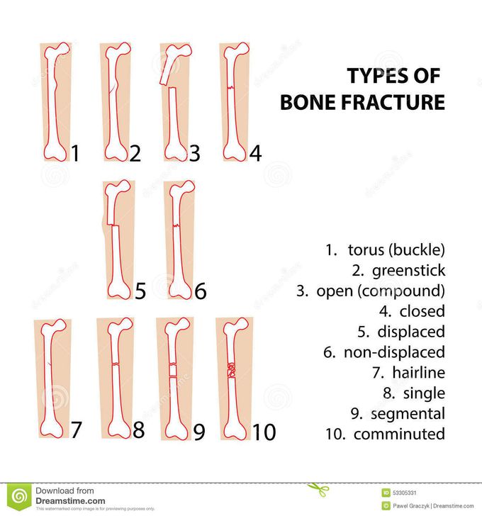 types of fracture