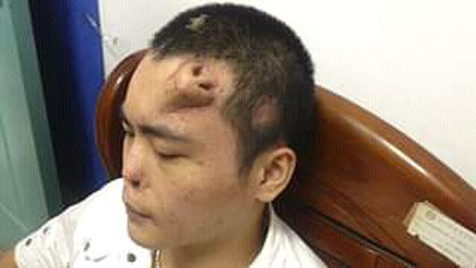 Birth defect