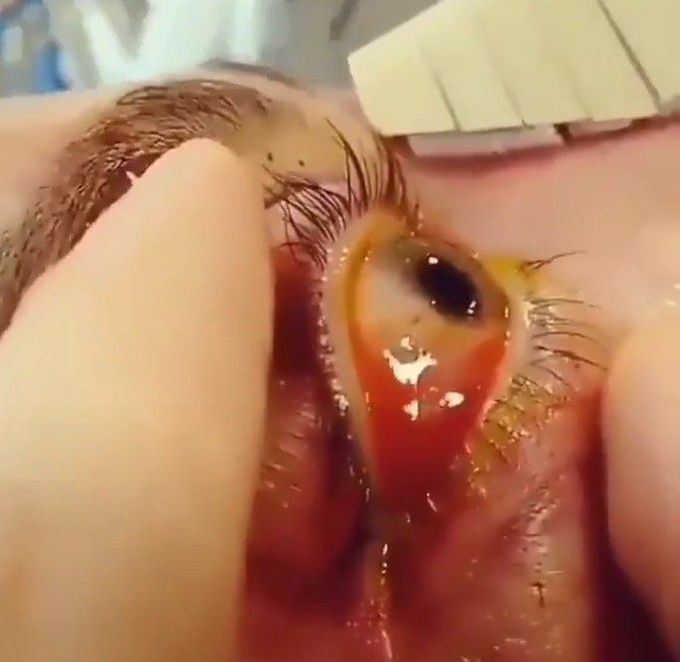 Pulsatile Exophthalmos