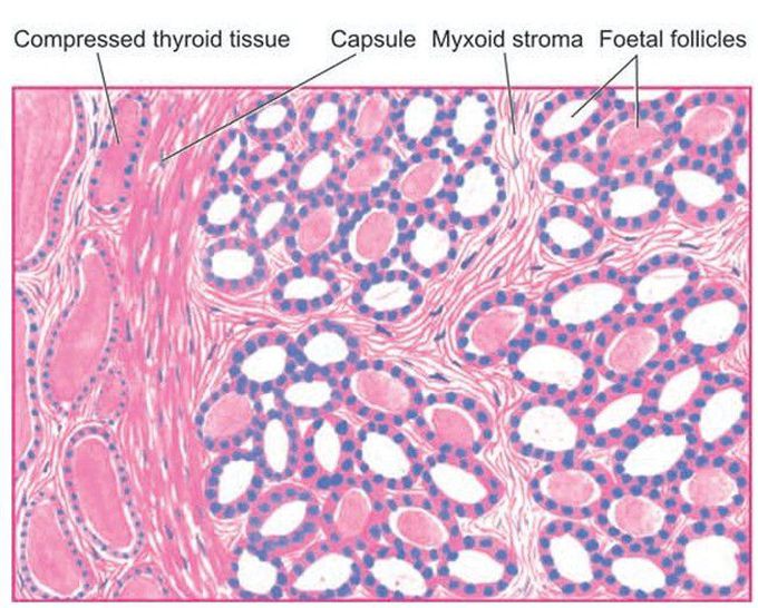 Follicular adenoma, foetal (microfollicular) type.