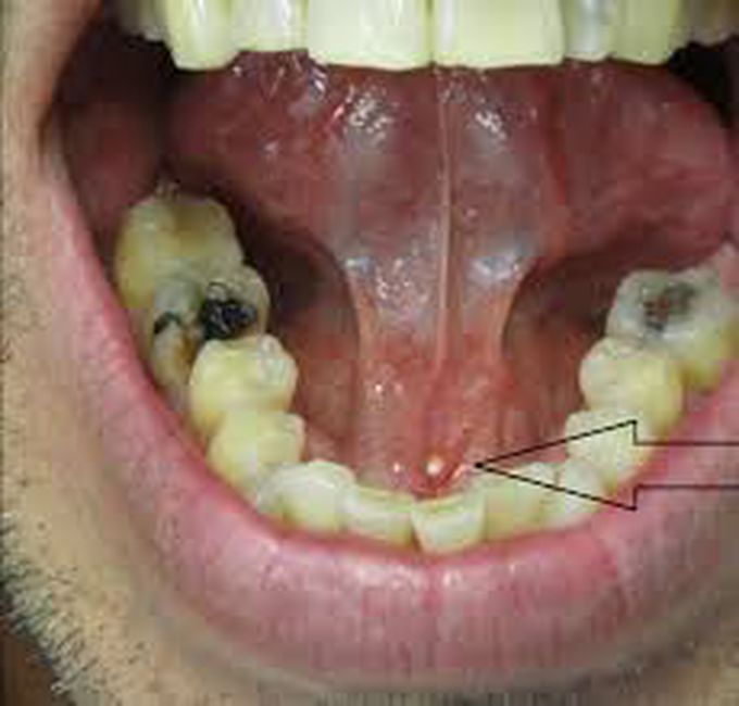Sialolithiasis