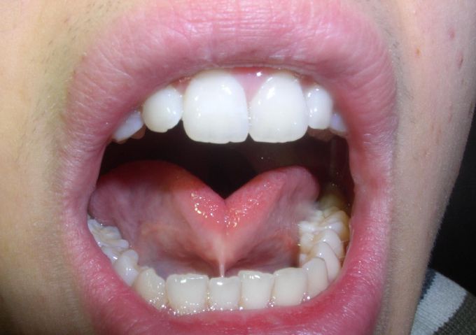 Causes of ankyloglossia