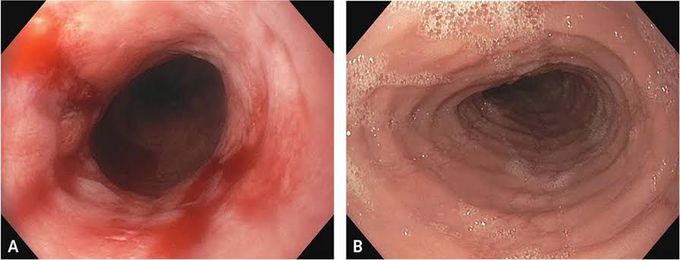 Eosinophilic Esophagitis